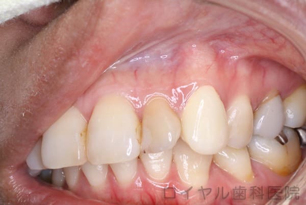 ジルコニアセラミック術前