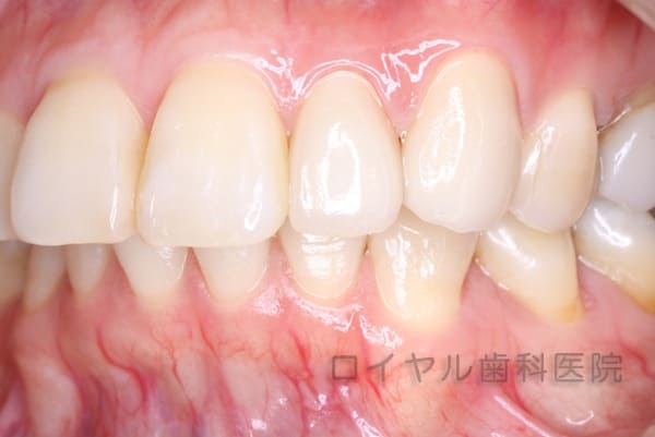 ジルコニアセラミック術後