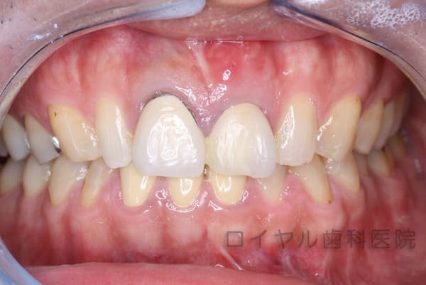 セラミック、ファイバーコア、歯肉形成の術前1