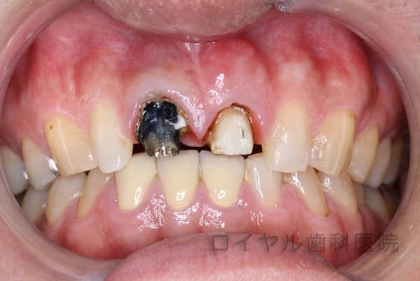 セラミック、ファイバーコア、歯肉形成の術前2