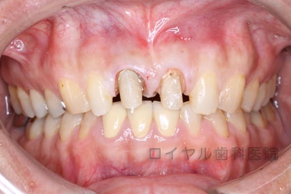 セラミック、ファイバーコア、歯肉形成の術中