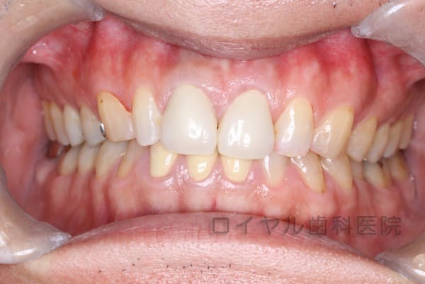 セラミック、ファイバーコア、歯肉形成の術後
