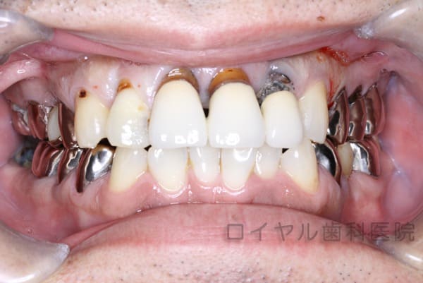 オールセラミッククラウン術前