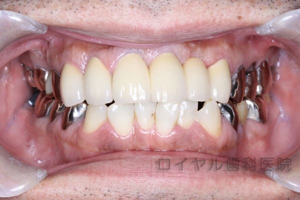 オールセラミッククラウン術後