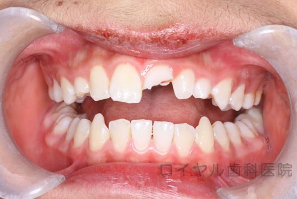 外傷による歯冠破折の治療の術前