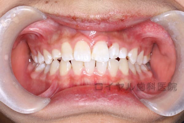 外傷による歯冠破折の治療の術後