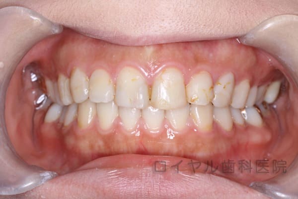 上顎オールセラミックの術前