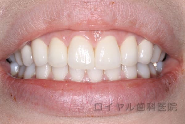 上顎オールセラミックの術後