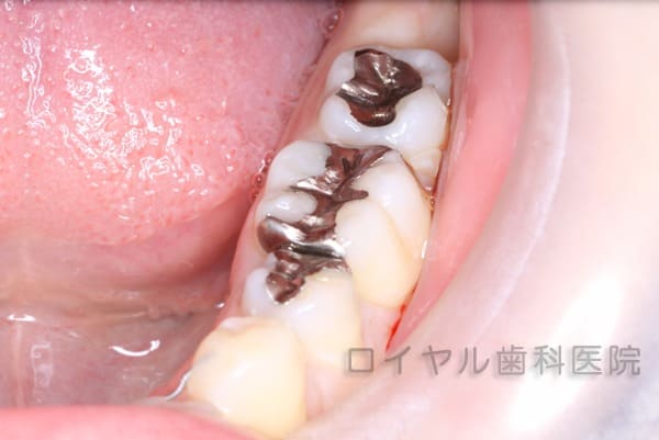 ポーセレンインレーの術前