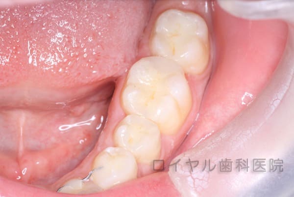 ポーセレンインレーの術後