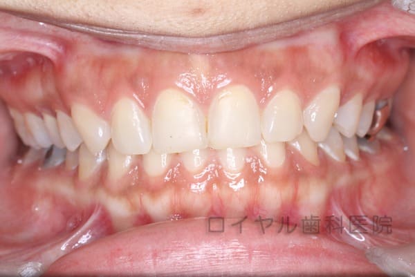 前歯のセラミックの術前