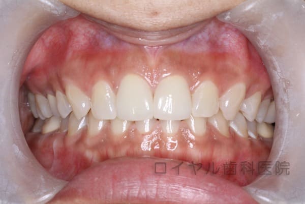 前歯のセラミックの術後