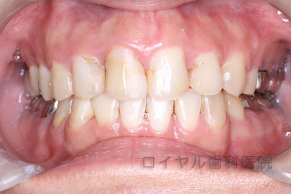 前歯のセラミックの術前