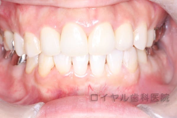 前歯のセラミックの術後