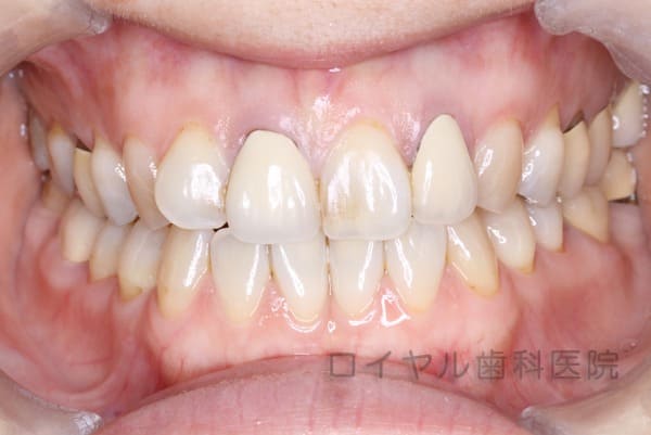 セラミックのケースの術前