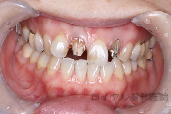 セラミックのケースの術中
