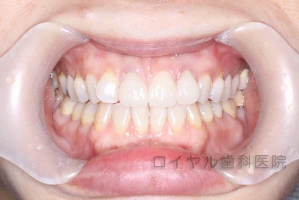 セラミックのケースの術後