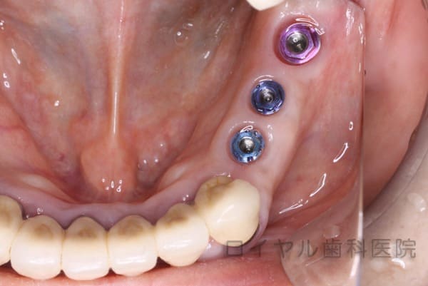 インプラント症例1術中