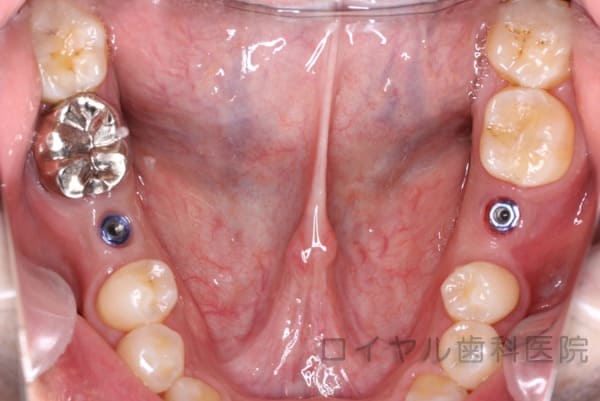 インプラント症例2術中