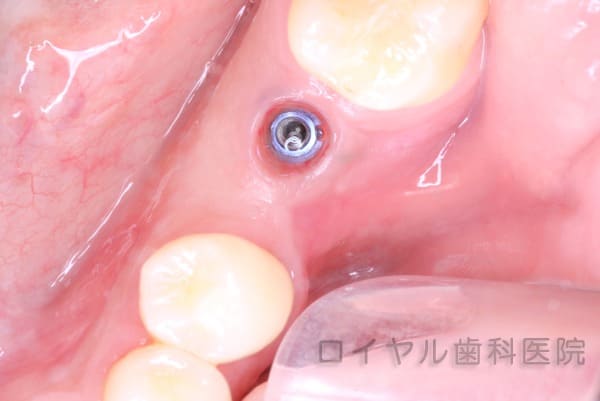 インプラント症例2術中