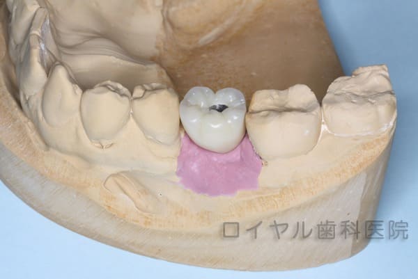 インプラント症例2模型作成2