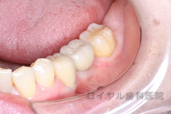 インプラント治療3術後