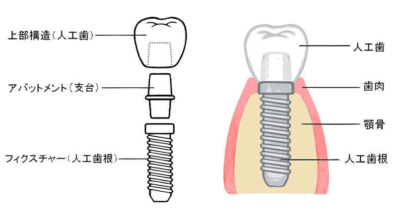 インプラントの構造