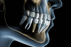 たまプラーザのロイヤル歯科医院のインプラント治療