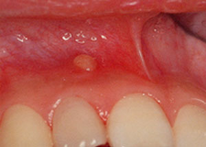 根尖由来による歯周膿瘍１