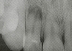 根尖由来による歯周膿瘍２