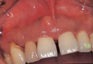 歯周炎由来による歯周膿瘍１