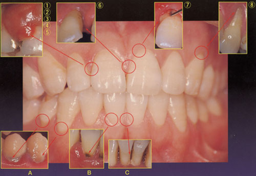 歯周病になるとどうなるの？