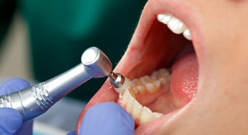 予防歯科・歯のメンテナンス
