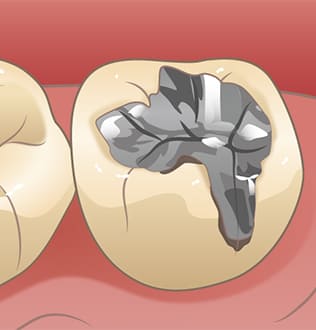 銀歯の下にむし歯がある状態