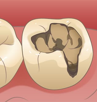 むし歯の再発と進行
