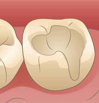 むし歯を取り除いたあと