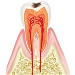 C１の場合（初期）