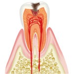 C２の場合（軽度）