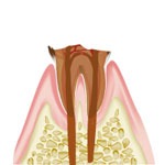 C４の場合（重度）