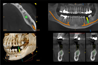 見えない顎の骨を可視化