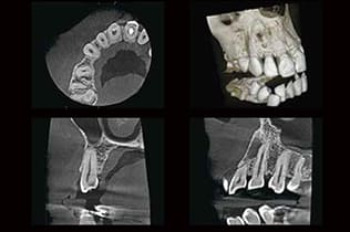 CTで成功率を高める根管治療