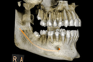 CTで神経の位置を把握し、リスクを最小限に