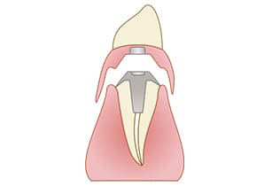 マグネットデンチャー