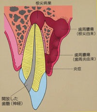 歯周膿瘍の原因
