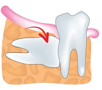 水平埋伏歯について