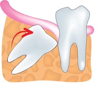 斜めに生えている親知らず