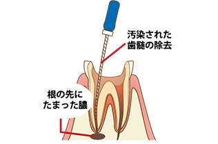 根管の清掃・形成