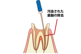 根管の清掃・形成