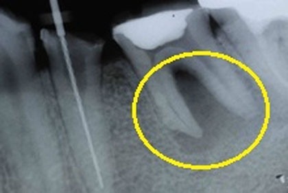 当院の根管治療術前