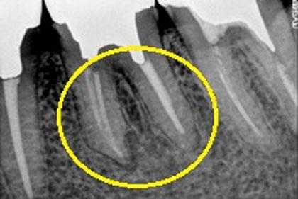 当院の根管治療術後